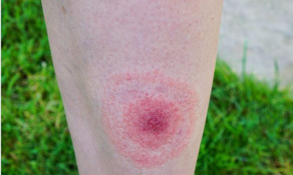 Importante hausse des cas de maladie de Lyme en Montérégie