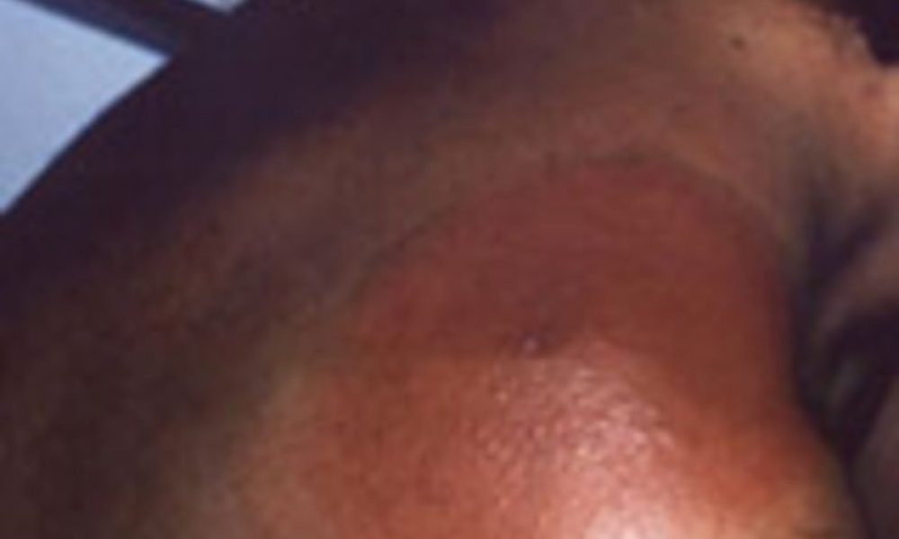 maladie de lyme: prudence en Montérégie