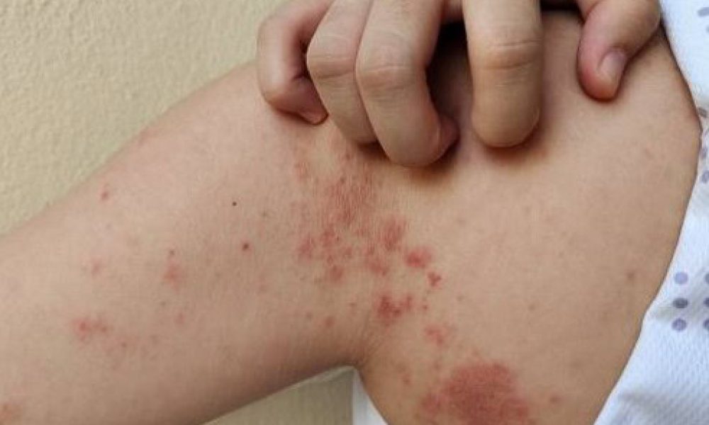 Mise en garde d’un cas de rougeole répertorié à Saint-Bruno